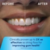 image:imageWaterpik Cordless Pearl Portable Water Flosser Rechargeable White  2 Settings 4 Tips for Daily Gum Health amp Cleaning Teeth Dental Braces Implants ADA Accepted WF13 Amazon ExclusivePearl White